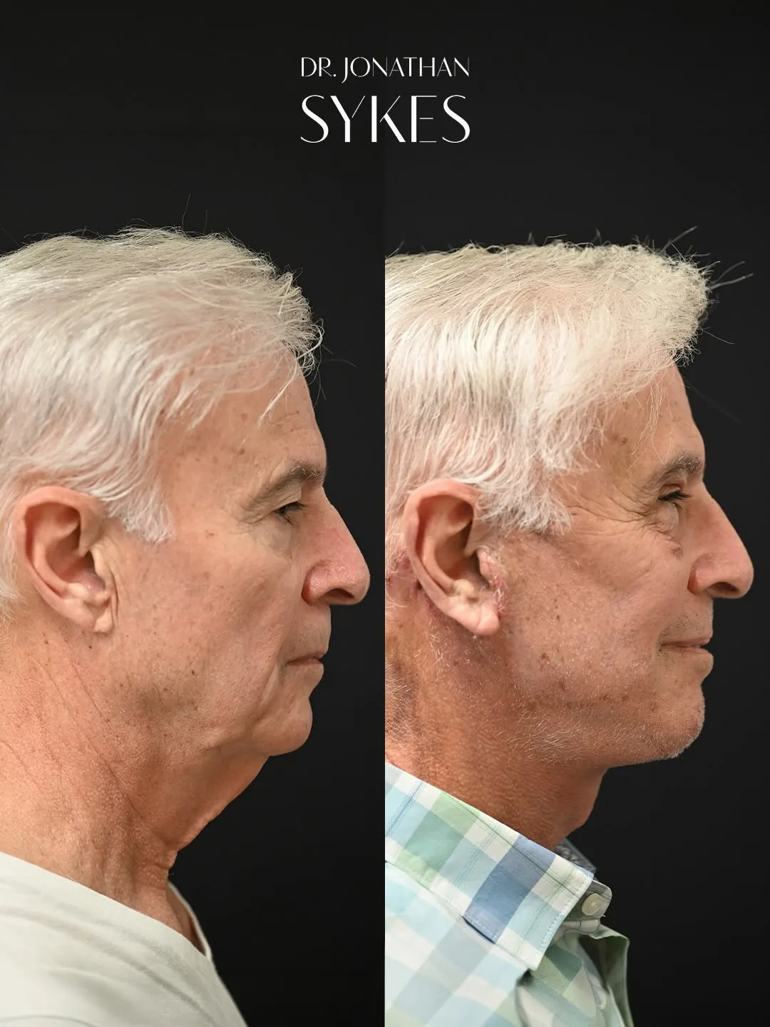 Before and after deep plane facelift — 68-year-old man, left profile view, 12mo post-op by Dr. Jonathan Sykes