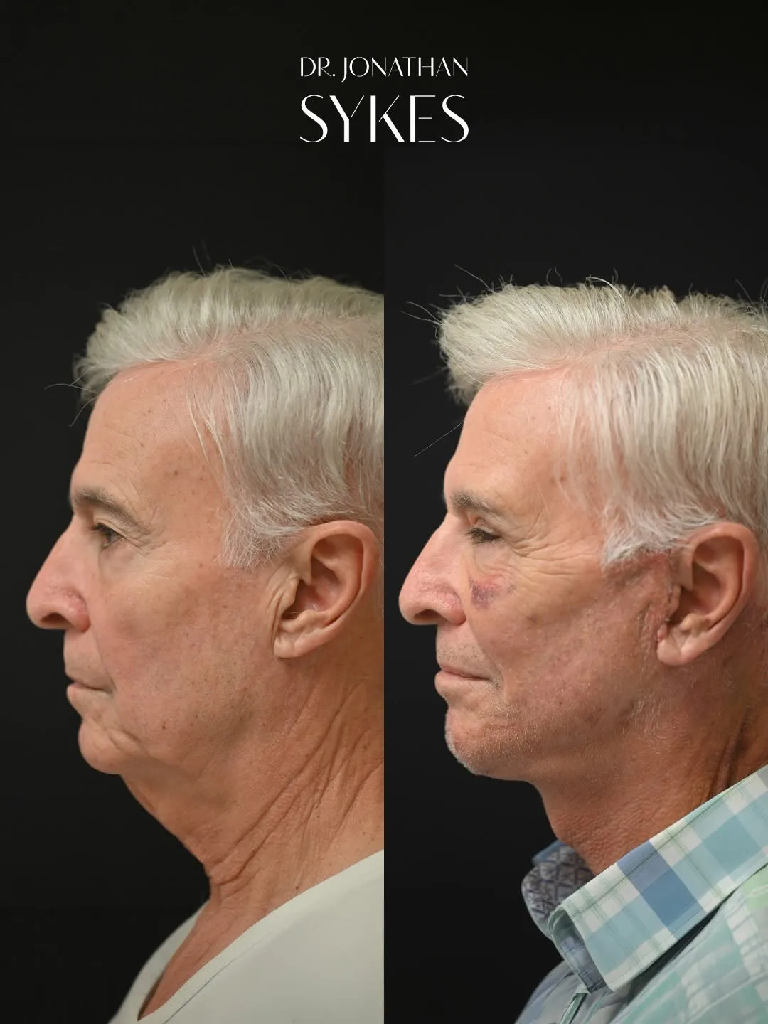 Before and after deep plane facelift — 65-year-old man, right profile view, 6mo post-op by Dr. Jonathan Sykes