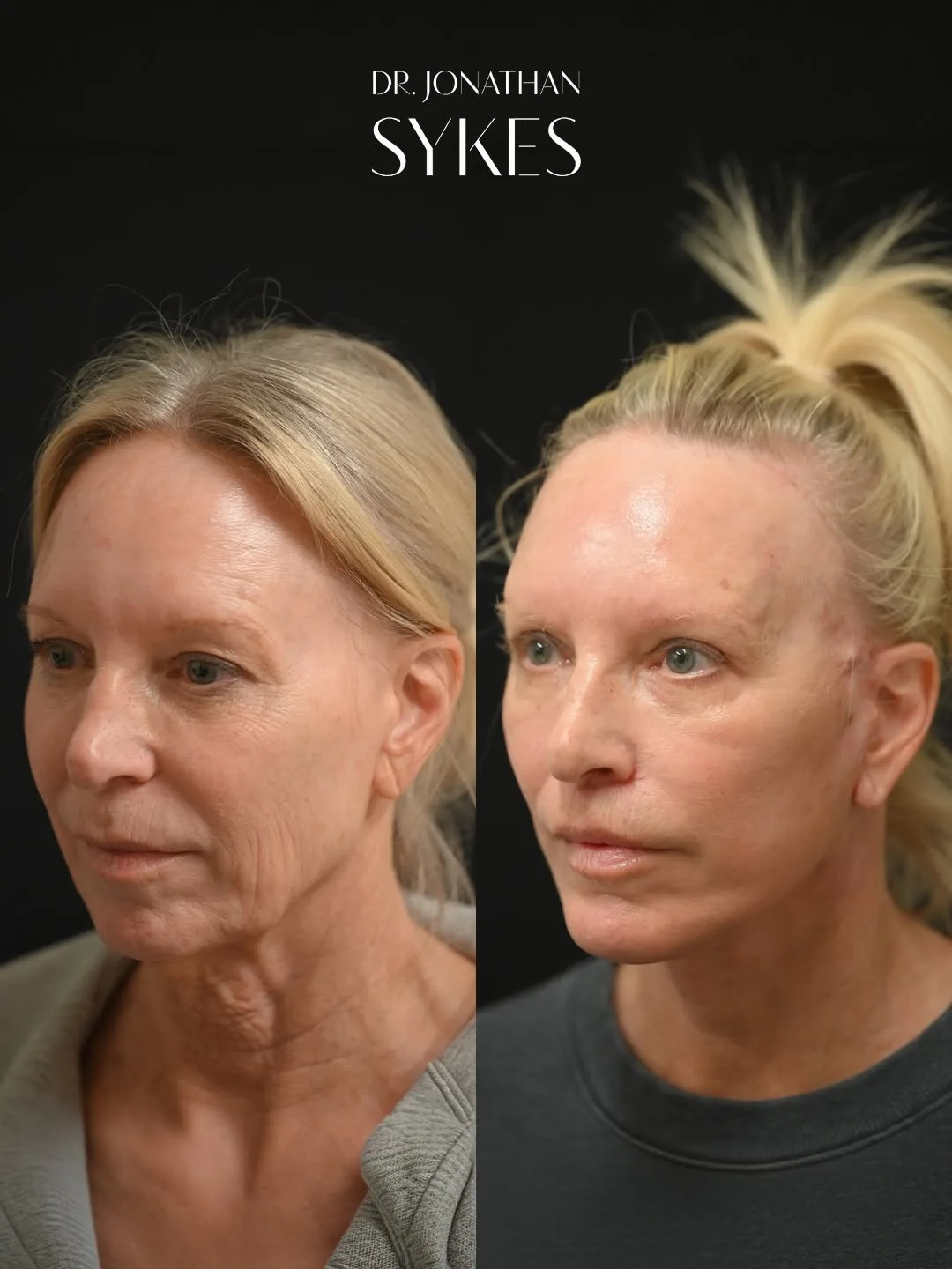 Before and after deep plane facelift — 58-year-old woman, three-quarter view, 2mo post-op by Dr. Jonathan Sykes