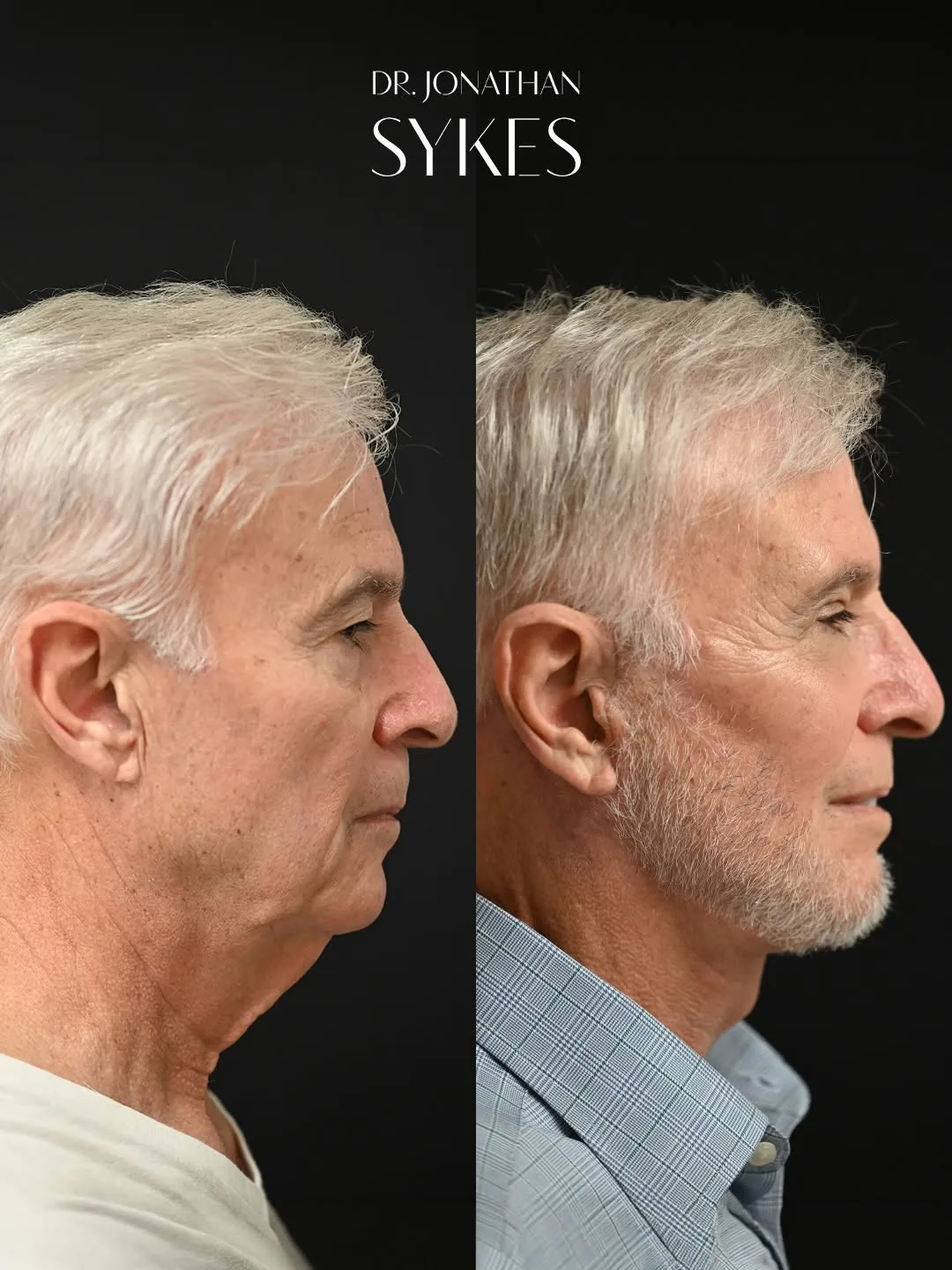 Before and after deep plane facelift — 65-year-old man, right profile view, 2mo post-op by Dr. Jonathan Sykes