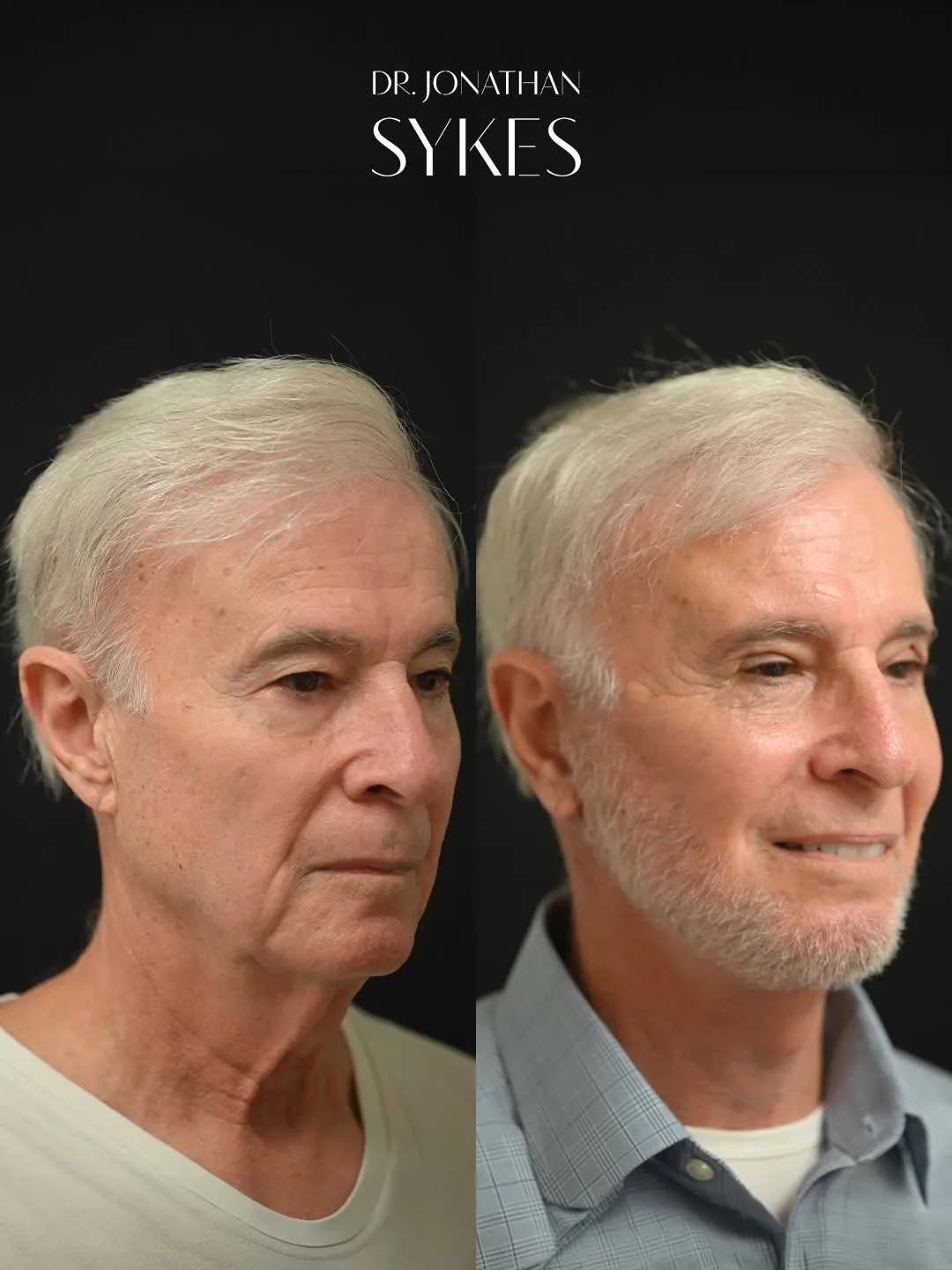 Before and after deep plane facelift — 73-year-old man, three-quarter view, 2mo post-op by Dr. Jonathan Sykes