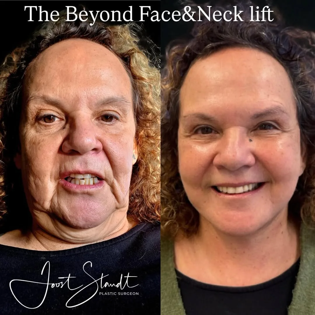 Before and after deep plane facelift — 65-year-old man, oblique right view, 6mo post-op by Dr. Joost Staudt