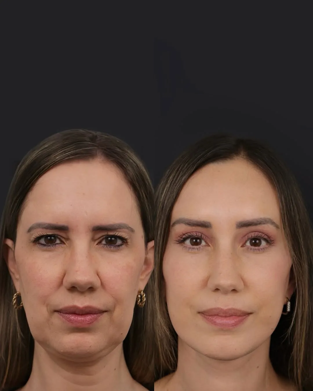 Before and after deep plane facelift — 45-year-old woman, frontal view, 1mo post-op by Dr. Jose Carlos Martins Neves