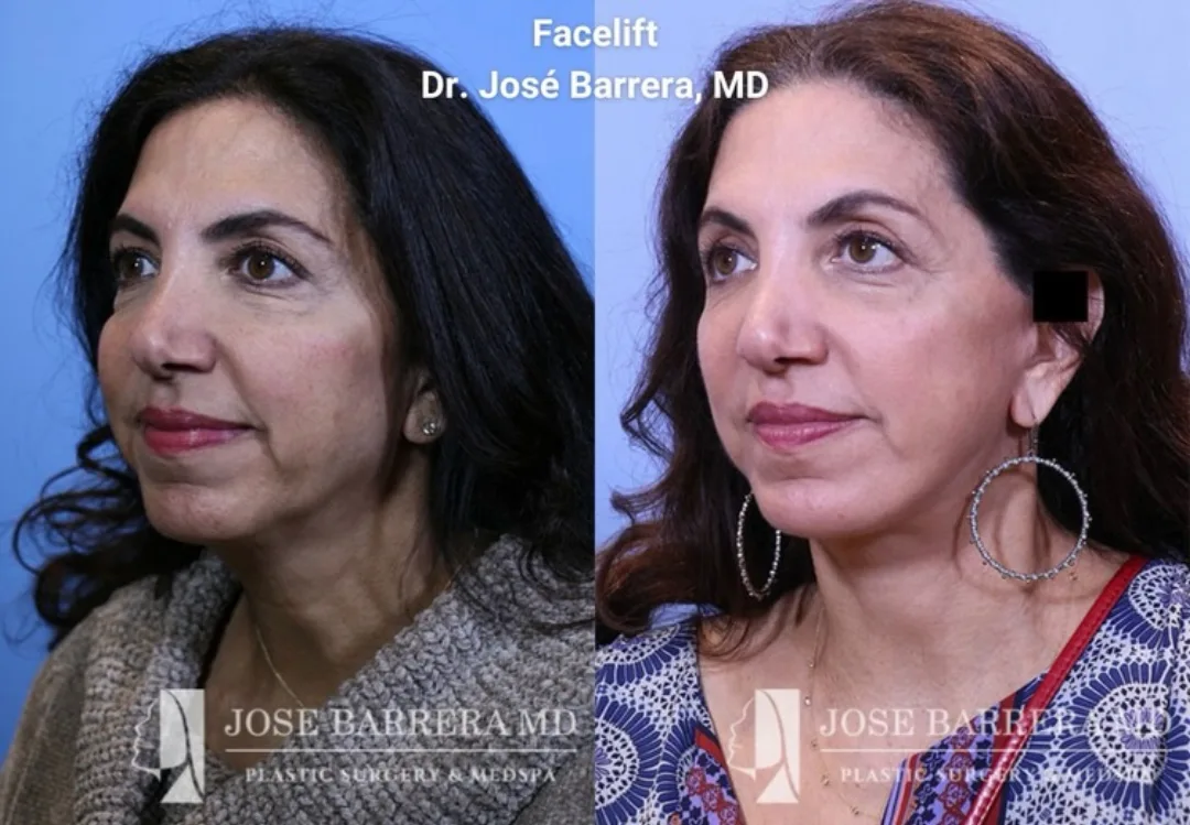 Before and after — Dr. José E. Barrera