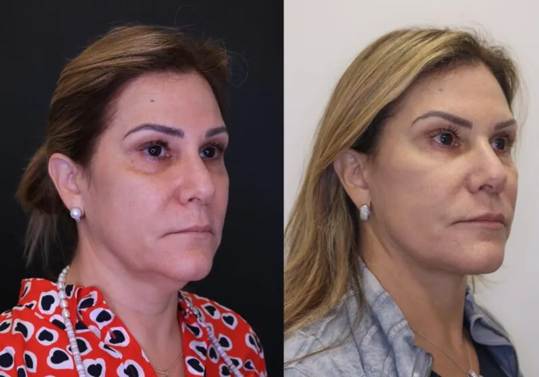 Before and after — Dr. Jose Rodriguez-Feliz