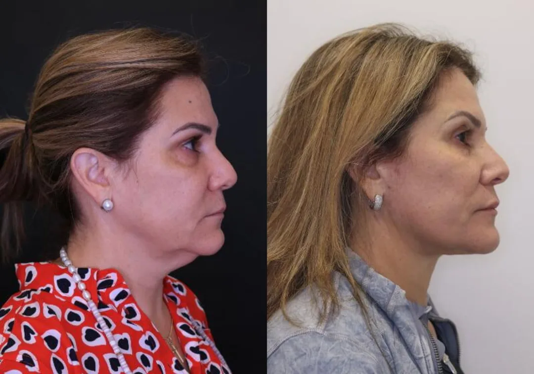 Before and after — Dr. Jose Rodriguez-Feliz