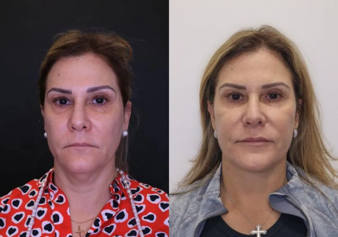 Before and after — Dr. Jose Rodriguez-Feliz