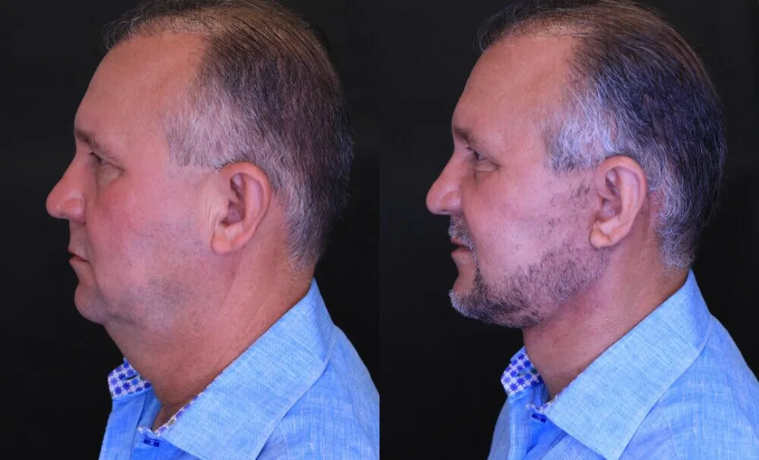 Before and after — Dr. Jose Rodriguez-Feliz