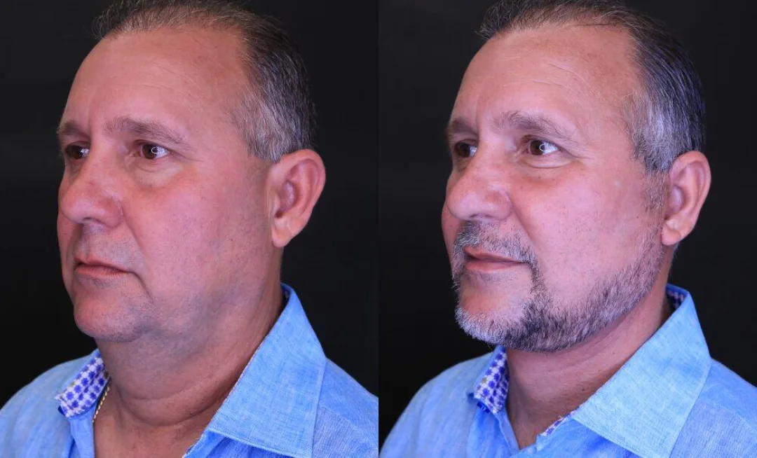 Before and after — Dr. Jose Rodriguez-Feliz