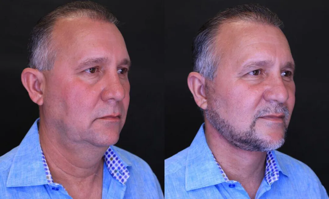 Before and after — Dr. Jose Rodriguez-Feliz