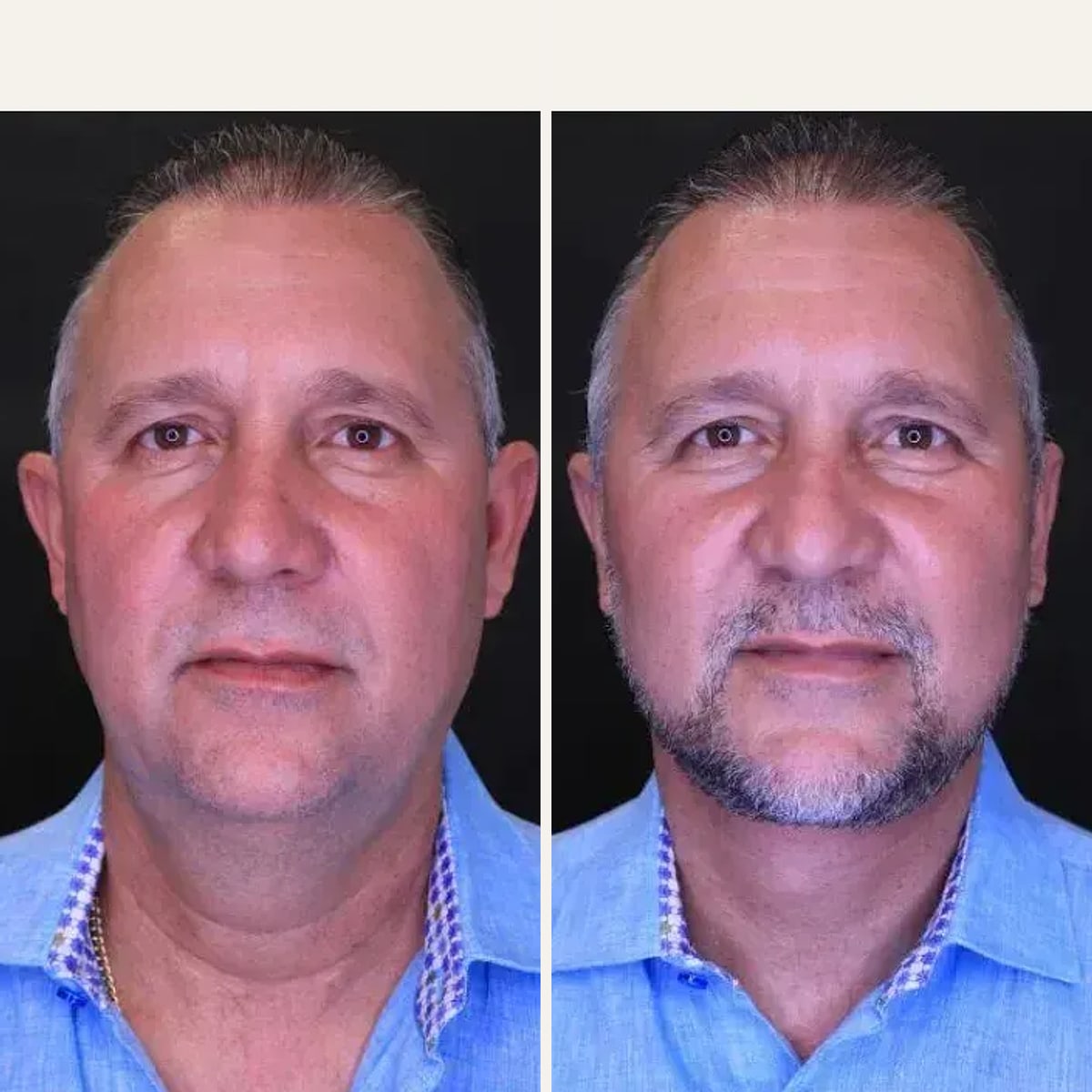 Voor en na: Dr. Jose Rodriguez-Feliz
