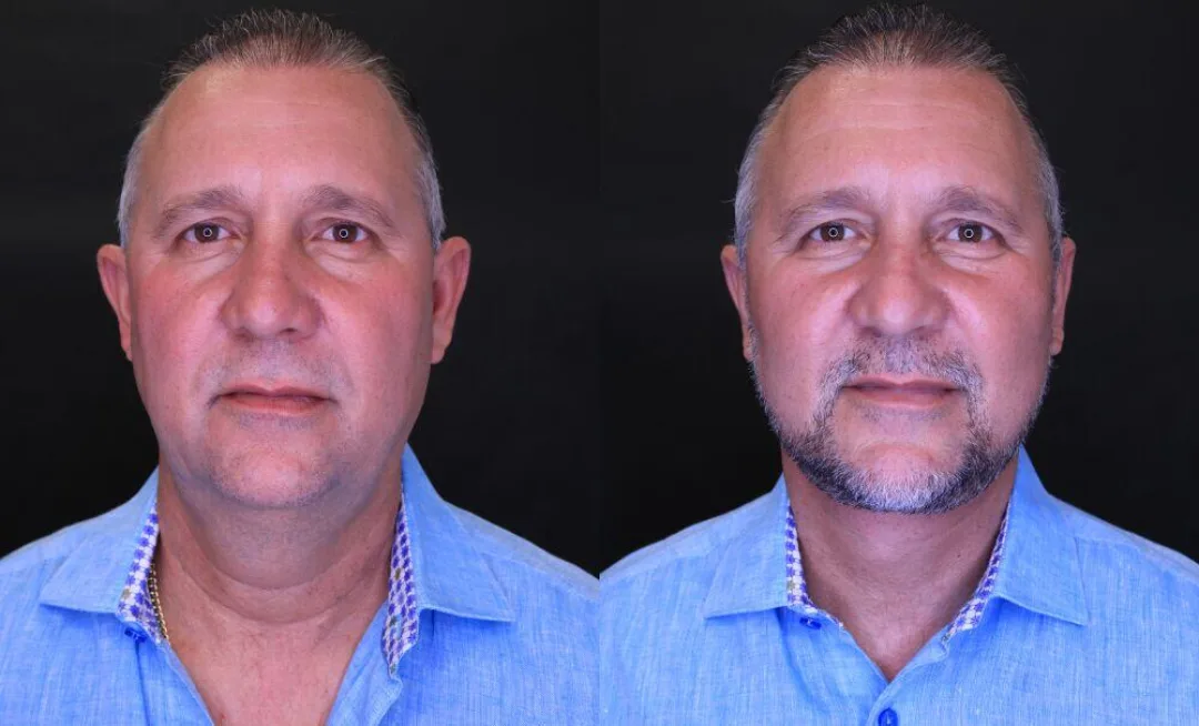 Before and after — Dr. Jose Rodriguez-Feliz