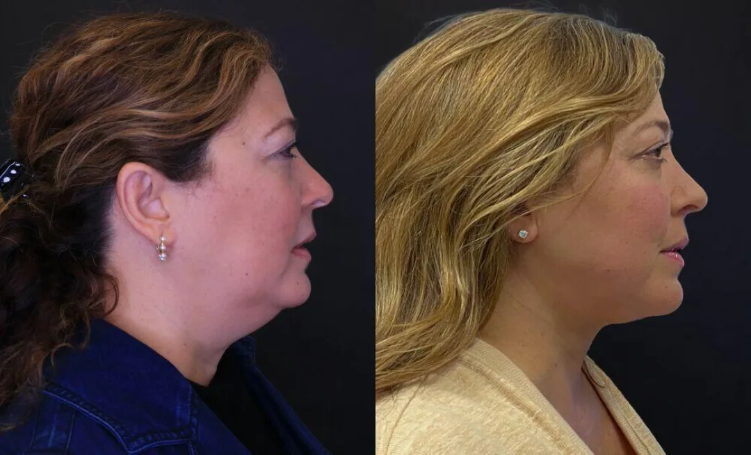 Before and after — Dr. Jose Rodriguez-Feliz