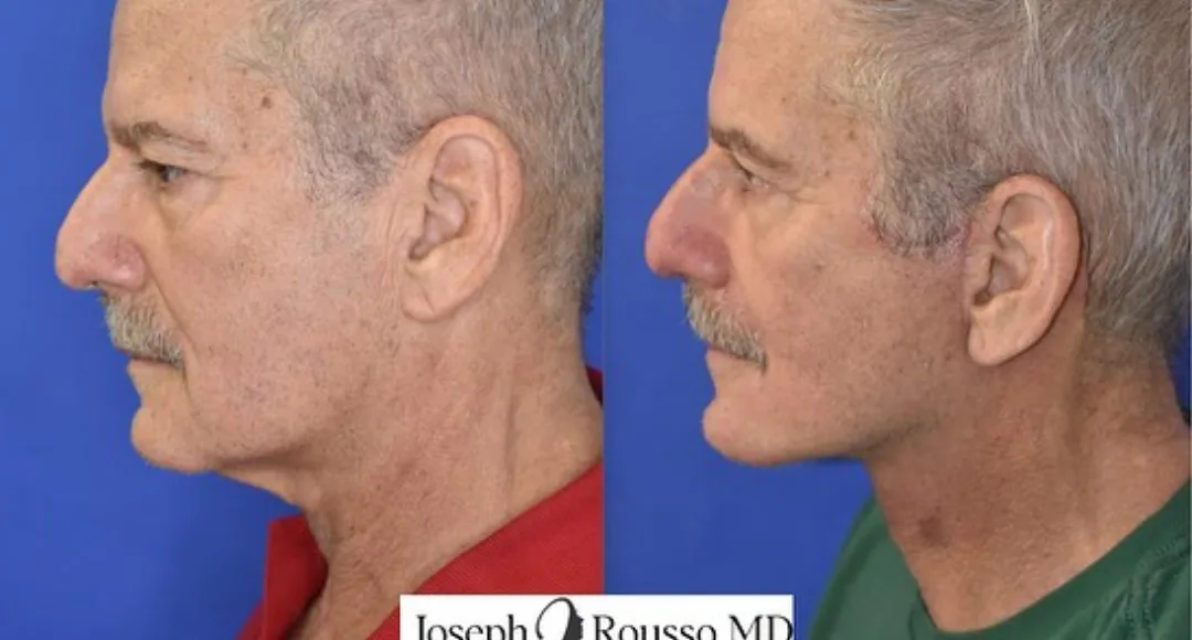 Before and after deep plane facelift — 58-year-old man, left profile view, 6mo post-op by Dr. Joseph Rousso
