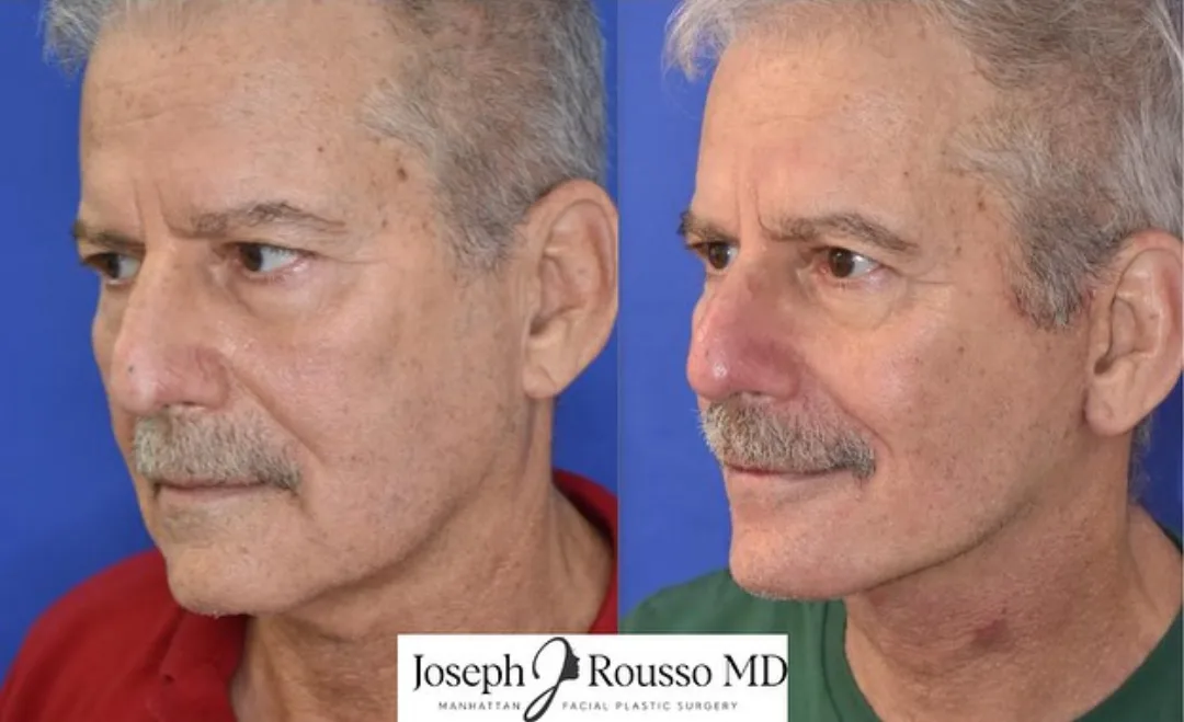 Before and after deep plane facelift — 58-year-old man, oblique left view, 7mo post-op by Dr. Joseph Rousso