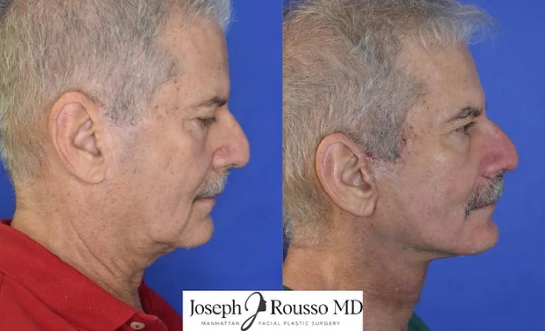 Before and after deep plane facelift — 58-year-old man, right profile view, 6mo post-op by Dr. Joseph Rousso
