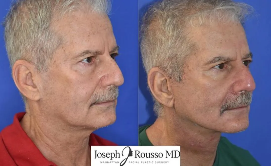 Before and after deep plane facelift — 62-year-old man, left profile view, 7mo post-op by Dr. Joseph Rousso