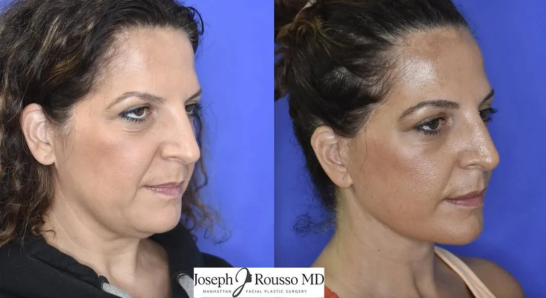 Before and after deep plane facelift — 52-year-old woman, three-quarter view, 8mo post-op by Dr. Joseph Rousso