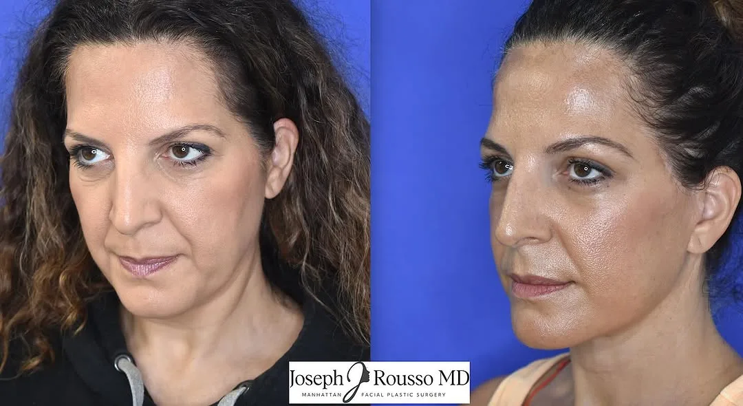 Before and after deep plane facelift — 48-year-old woman, three-quarter view, 8mo post-op by Dr. Joseph Rousso