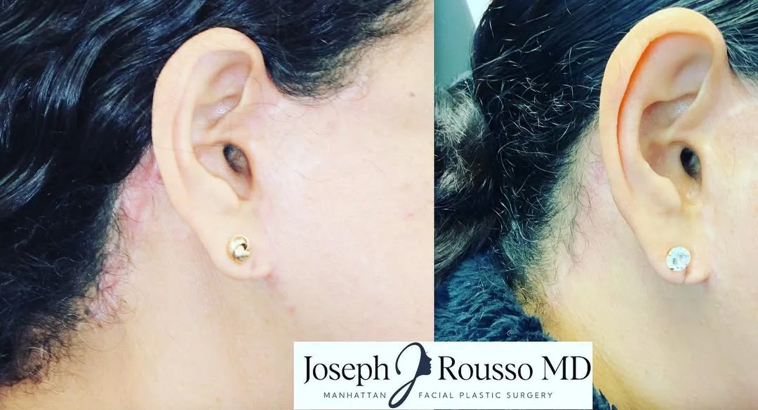 Before and after deep plane facelift — 35-year-old woman, frontal view, 6mo post-op by Dr. Joseph Rousso