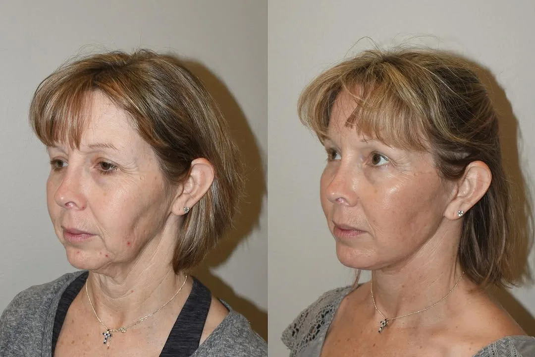 Before and after deep plane facelift — 58-year-old woman, oblique right view, 6mo post-op by Dr. Joseph Russell