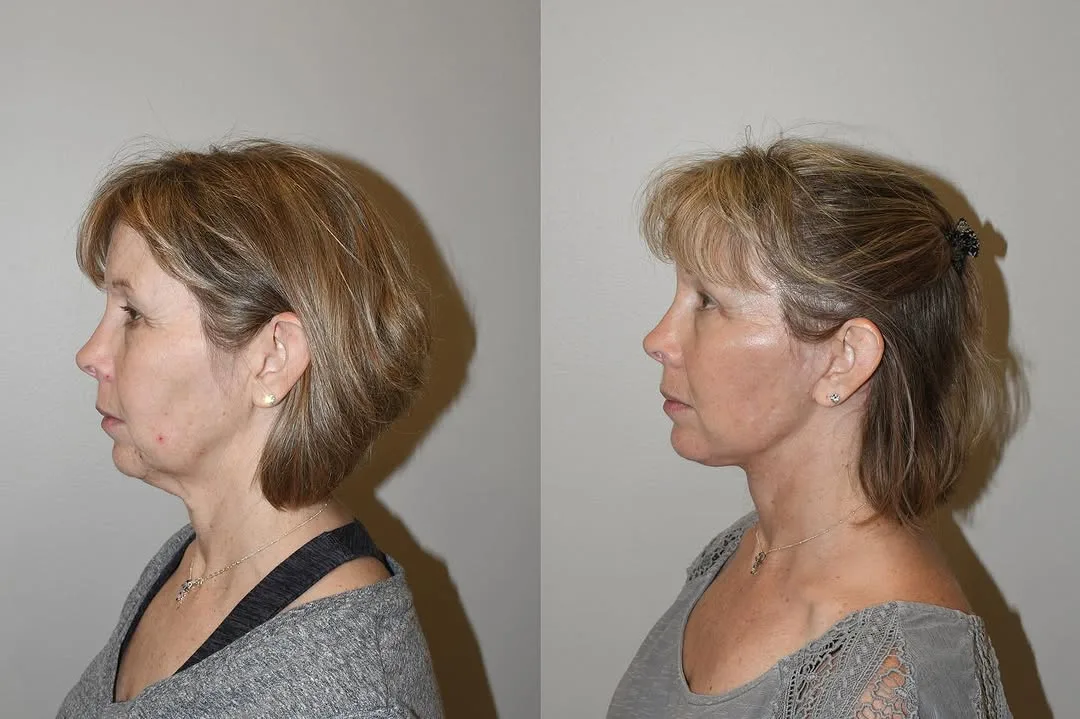 Before and after, Deep Plane Facelift