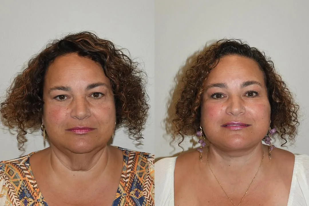Before and after deep plane facelift — 52-year-old woman, frontal view, 1mo post-op by Dr. Joseph Russell