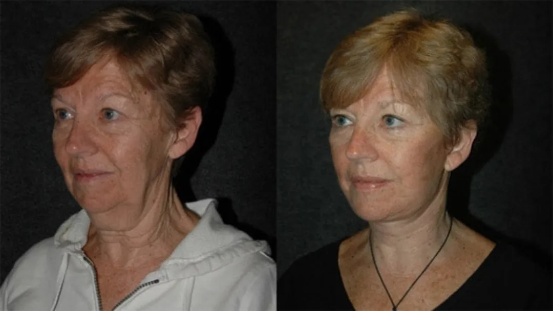 Before and after deep plane facelift — 55-year-old woman, oblique left view, 6mo post-op by Dr. Joseph Russell