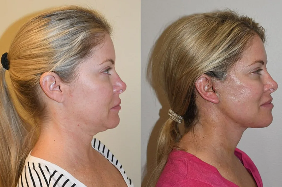 Before and after deep plane facelift — 48-year-old woman, right profile view, 6mo post-op by Dr. Joseph Russell