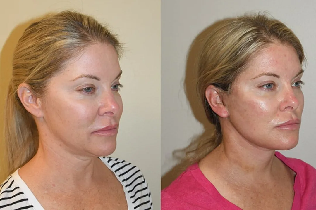 Before and after deep plane facelift — 52-year-old woman, oblique left view, 6mo post-op by Dr. Joseph Russell