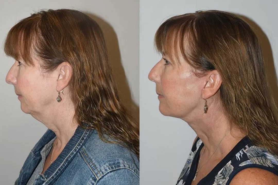 Before and after deep plane facelift — 55-year-old woman, oblique right view, 6mo post-op by Dr. Joseph Russell