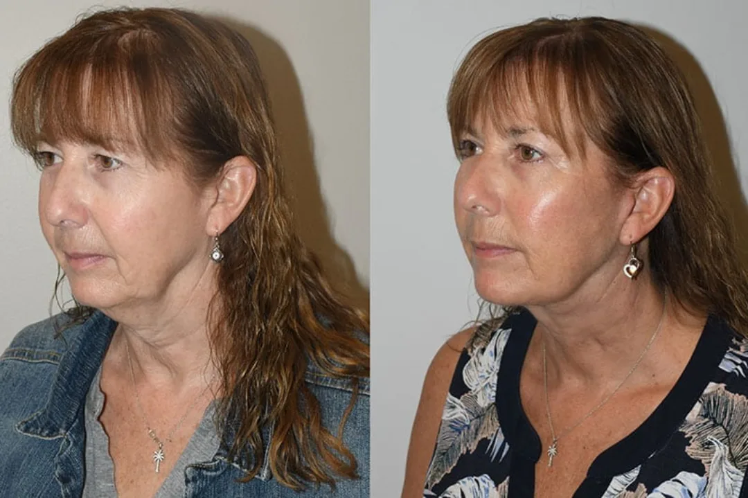 Before and after deep plane facelift — 55-year-old woman, oblique left view, 6mo post-op by Dr. Joseph Russell