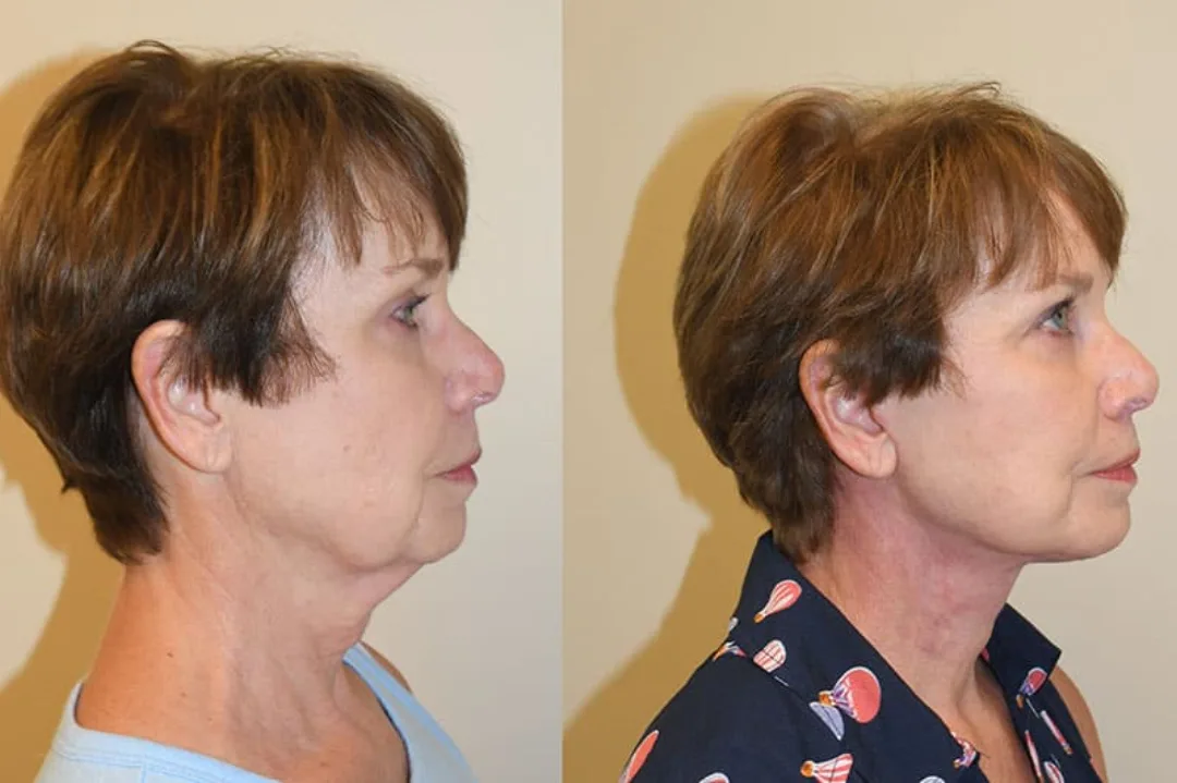 Before and after deep plane facelift — 58-year-old woman, left profile view, 6mo post-op by Dr. Joseph Russell