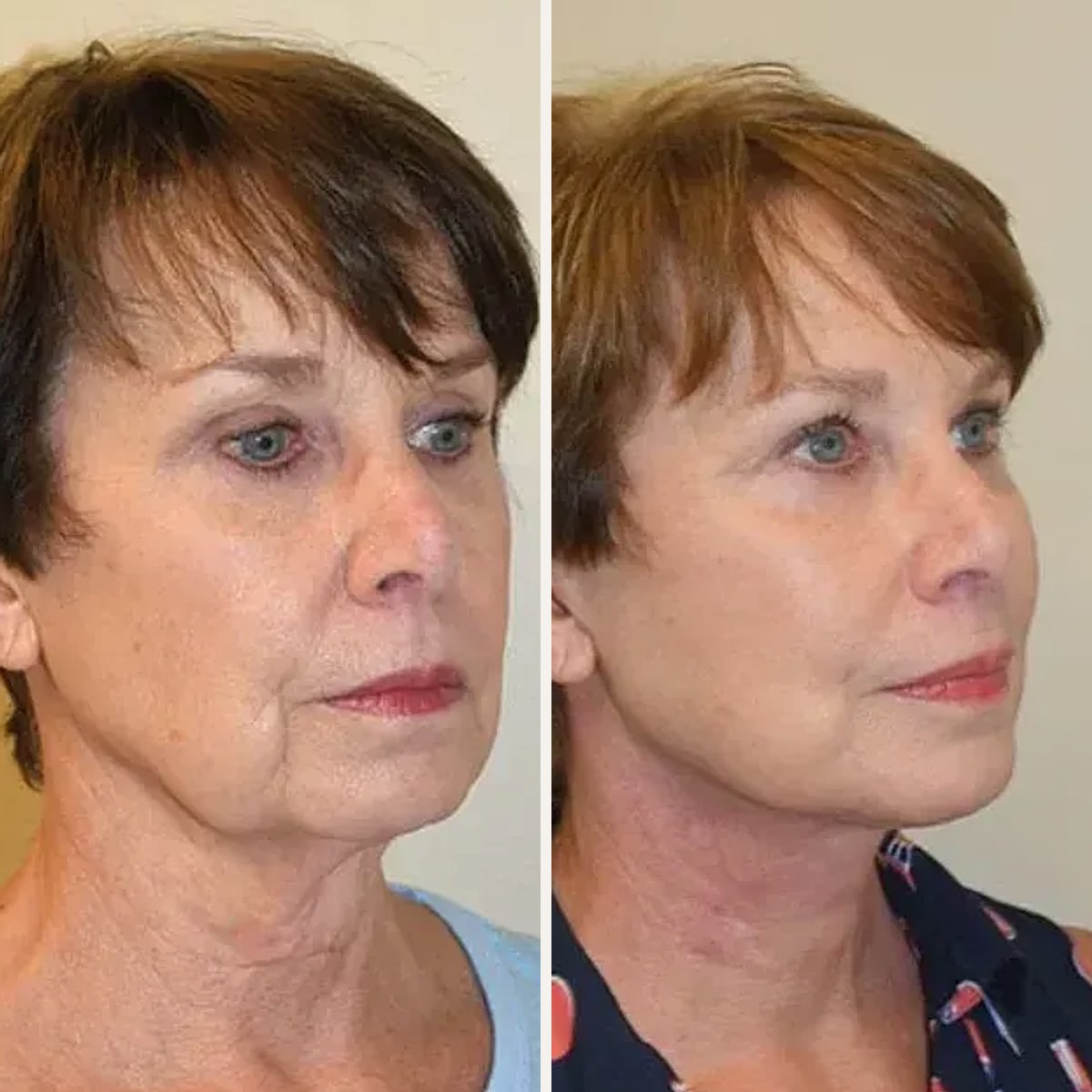 Before and after, Deep Plane Facelift