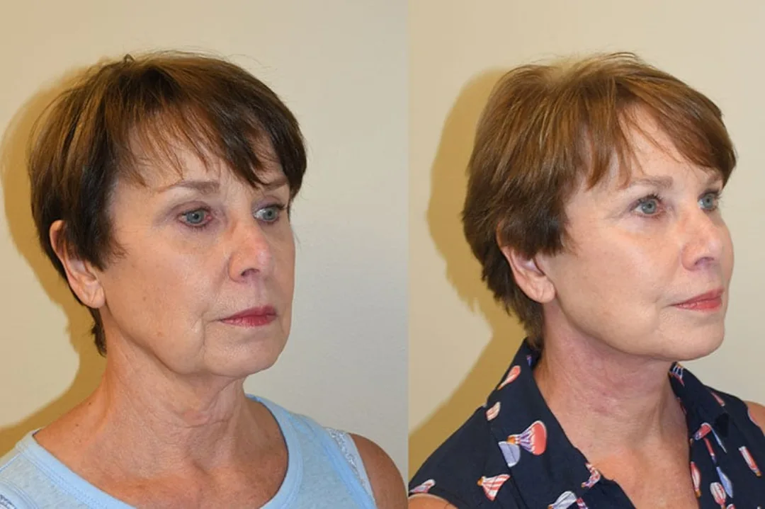 Before and after deep plane facelift — 58-year-old woman, oblique right view, 7mo post-op by Dr. Joseph Russell