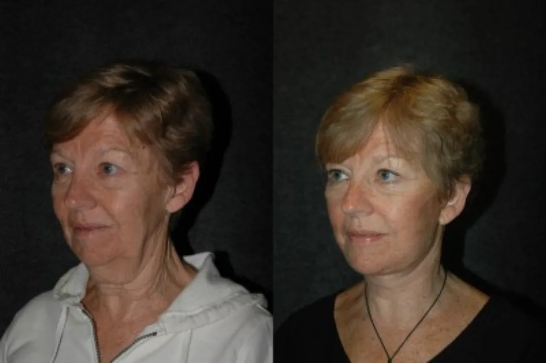 Before and after deep plane facelift — 55-year-old woman, oblique left view, 6mo post-op by Dr. Joseph Russell
