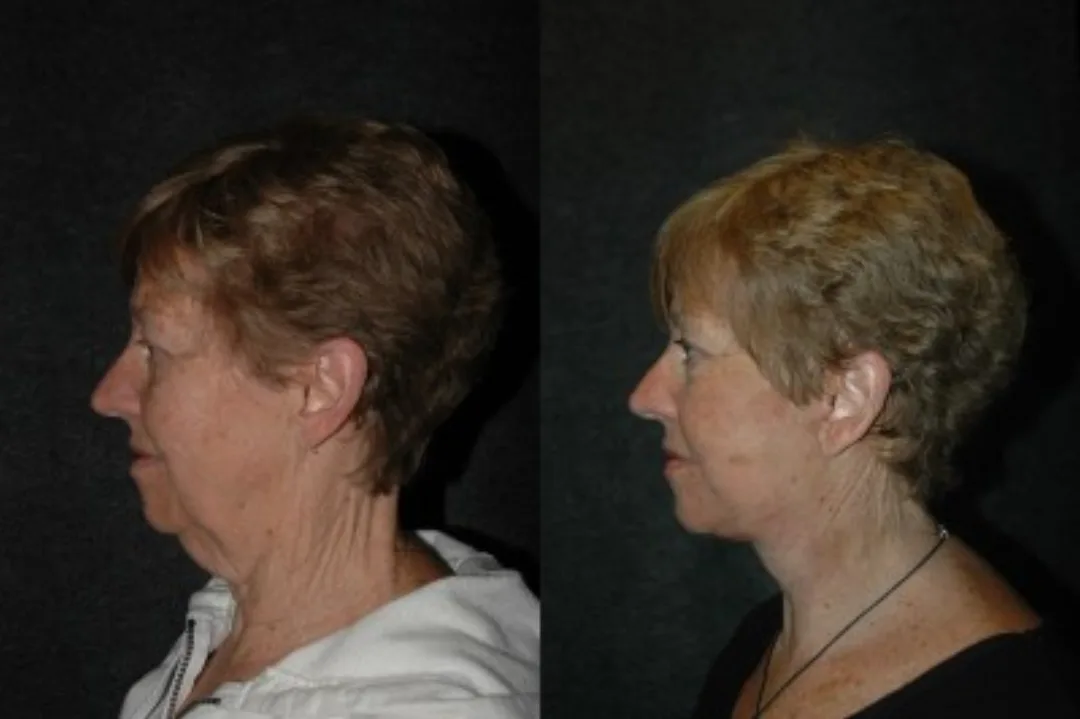 Before and after deep plane facelift — 58-year-old woman, left profile view, 6mo post-op by Dr. Joseph Russell