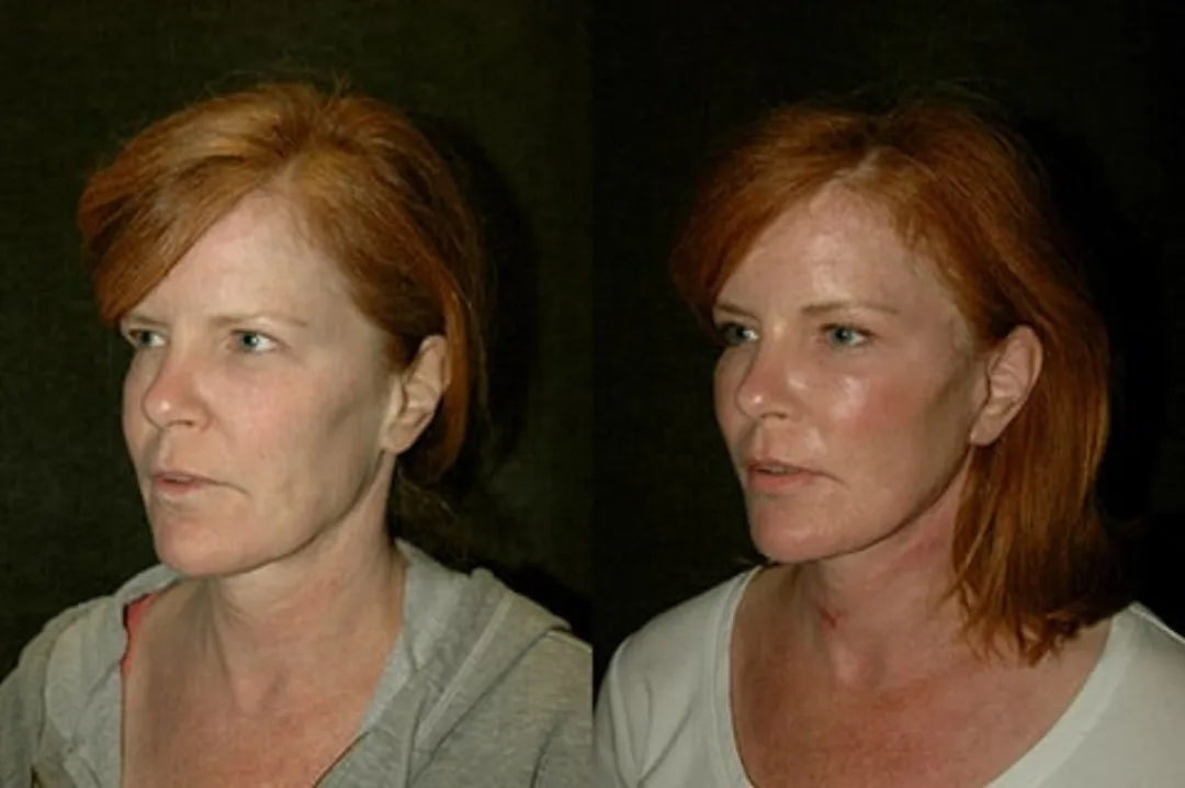 Before and after deep plane facelift — 52-year-old woman, oblique left view, 6mo post-op by Dr. Joseph Russell