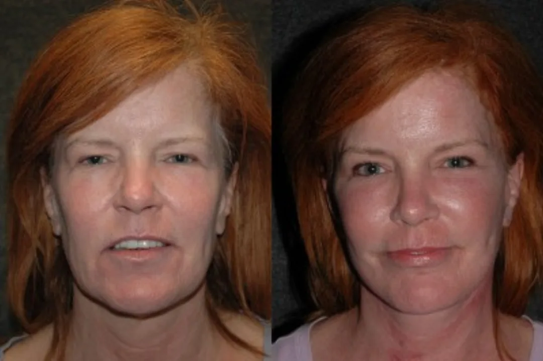 Before and after deep plane facelift — 52-year-old woman, oblique right view, 6mo post-op by Dr. Joseph Russell