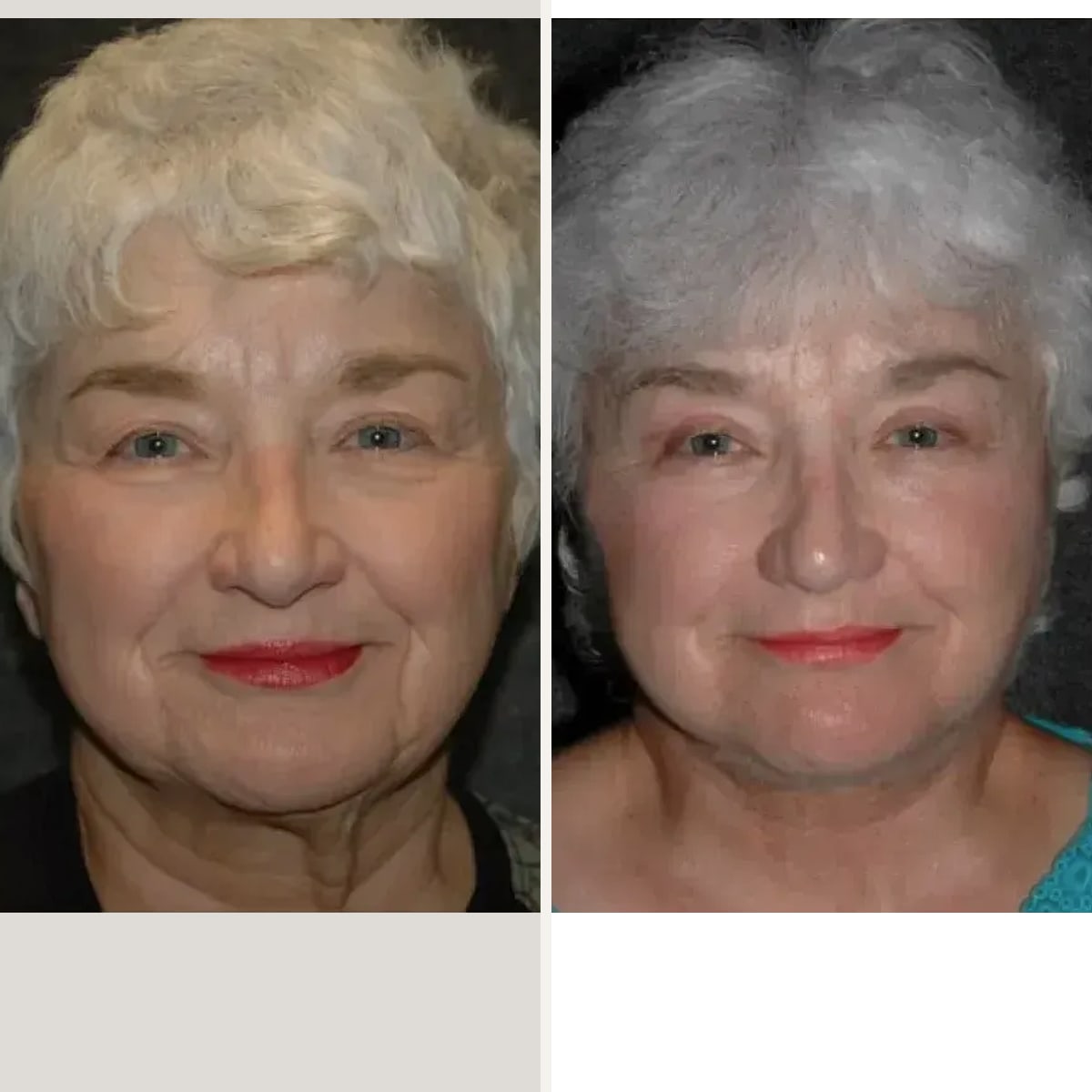 Before and after, Deep Plane Facelift