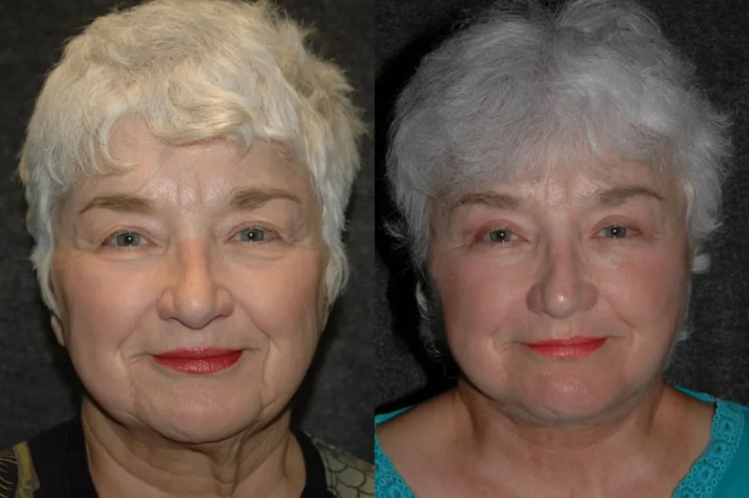 Before and after deep plane facelift — 72-year-old woman, frontal view, 7mo post-op by Dr. Joseph Russell