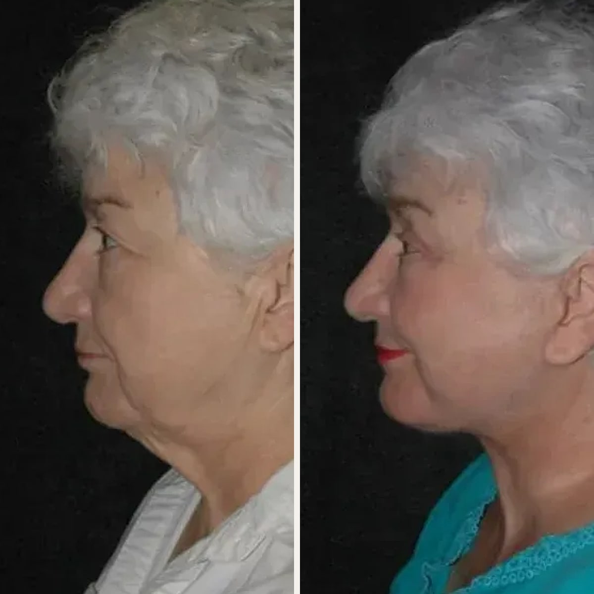 Before and after, Deep Plane Facelift