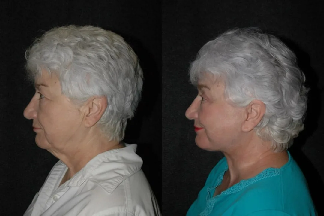 Before and after deep plane facelift — 72-year-old woman, left profile view, 9mo post-op by Dr. Joseph Russell