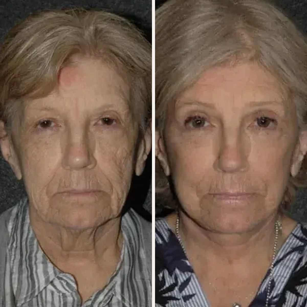 Before and after, Deep Plane Facelift