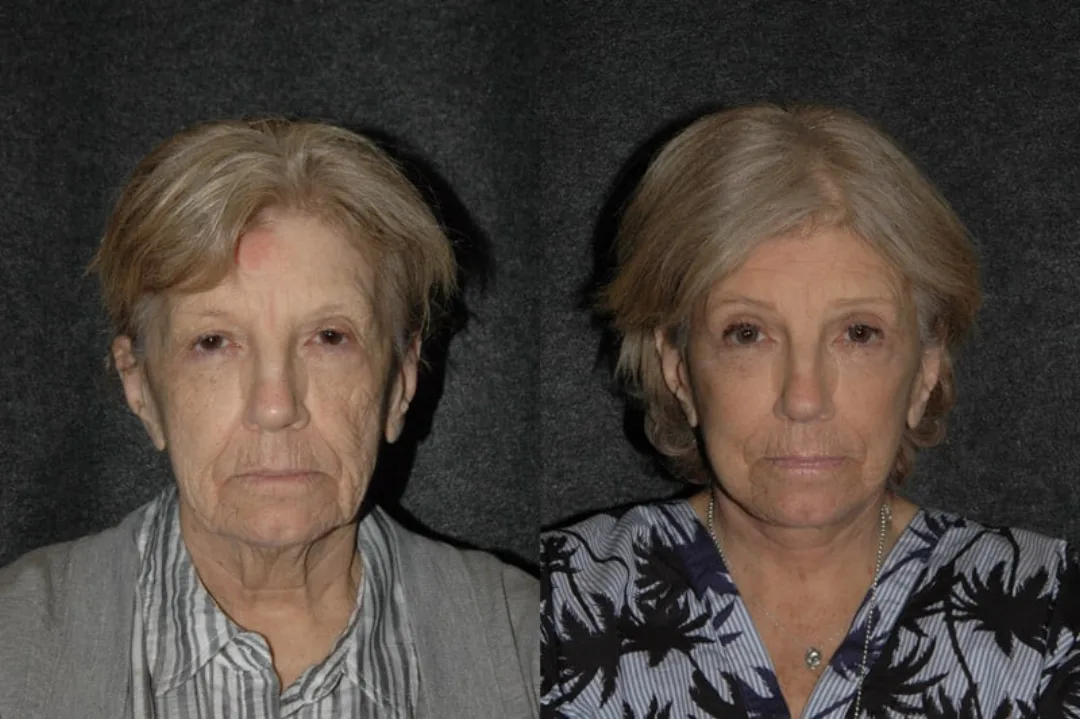 Before and after deep plane facelift — 65-year-old woman, frontal view, 7mo post-op by Dr. Joseph Russell