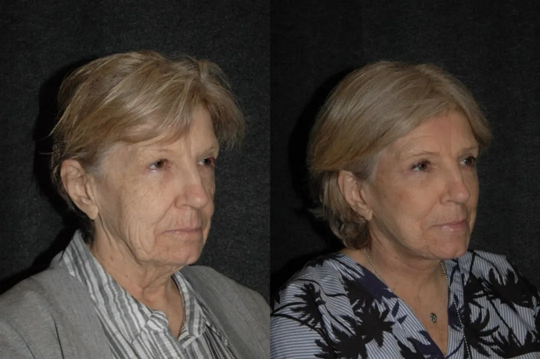 Before and after deep plane facelift — 72-year-old woman, oblique left view, 6mo post-op by Dr. Joseph Russell