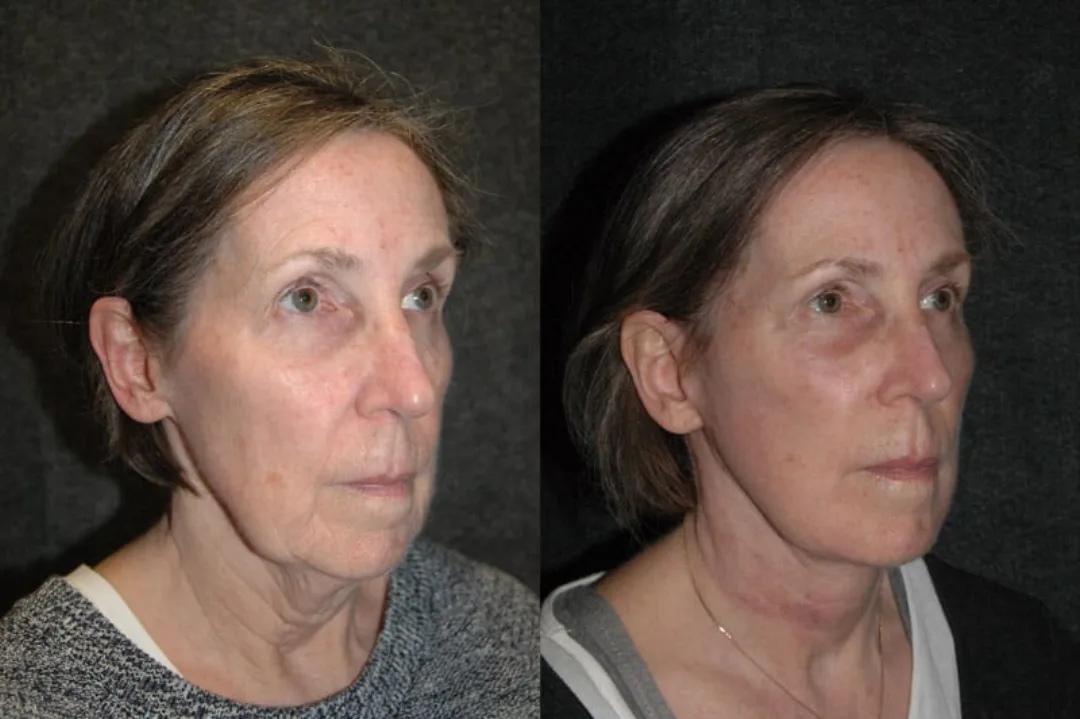 Before and after deep plane facelift — 58-year-old woman, oblique right view, 6mo post-op by Dr. Joseph Russell