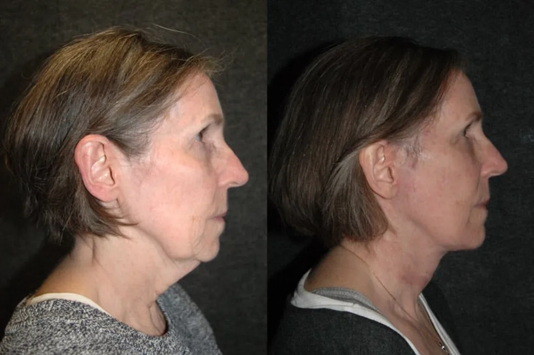Before and after deep plane facelift — 55-year-old woman, left profile view, 6mo post-op by Dr. Joseph Russell