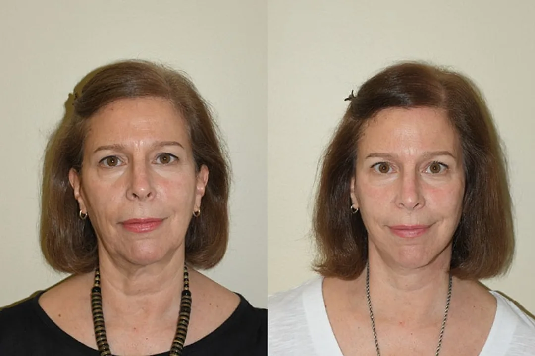 Before and after deep plane facelift — 52-year-old woman, frontal view, 6mo post-op by Dr. Joseph Russell