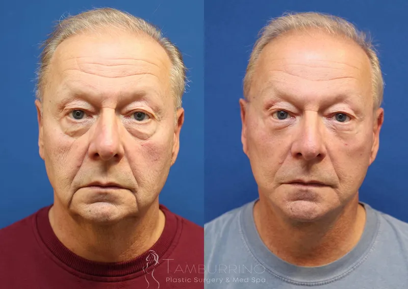 Before and after — Dr. Joseph Tamburrino